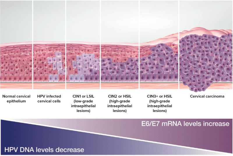 hpv-dna-levels.png Acog_Logo